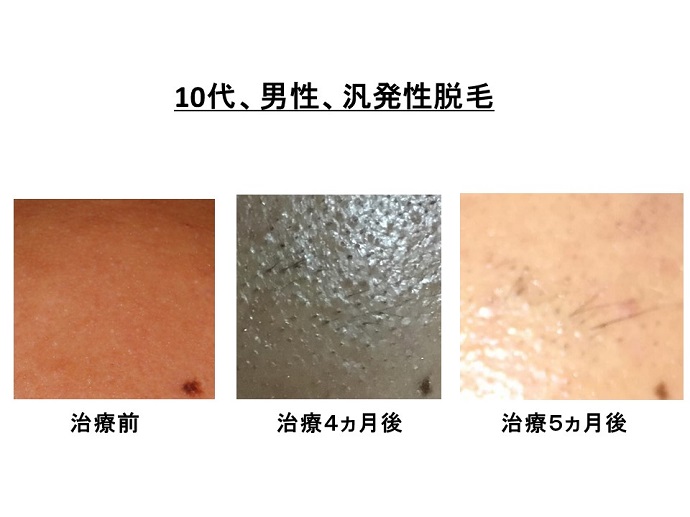 円形脱毛症　病院